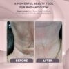 Dispositivo de Belleza para el rejuvenecimento de la piel - Imagen 4